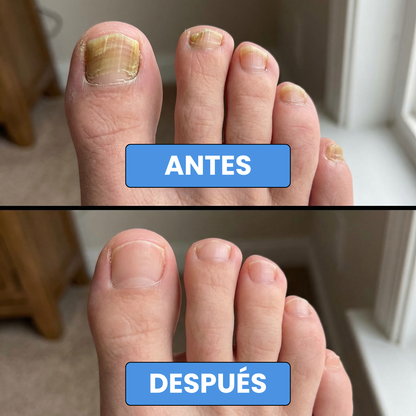 Onyclair® - Parches Naturales Para Tus Uñas