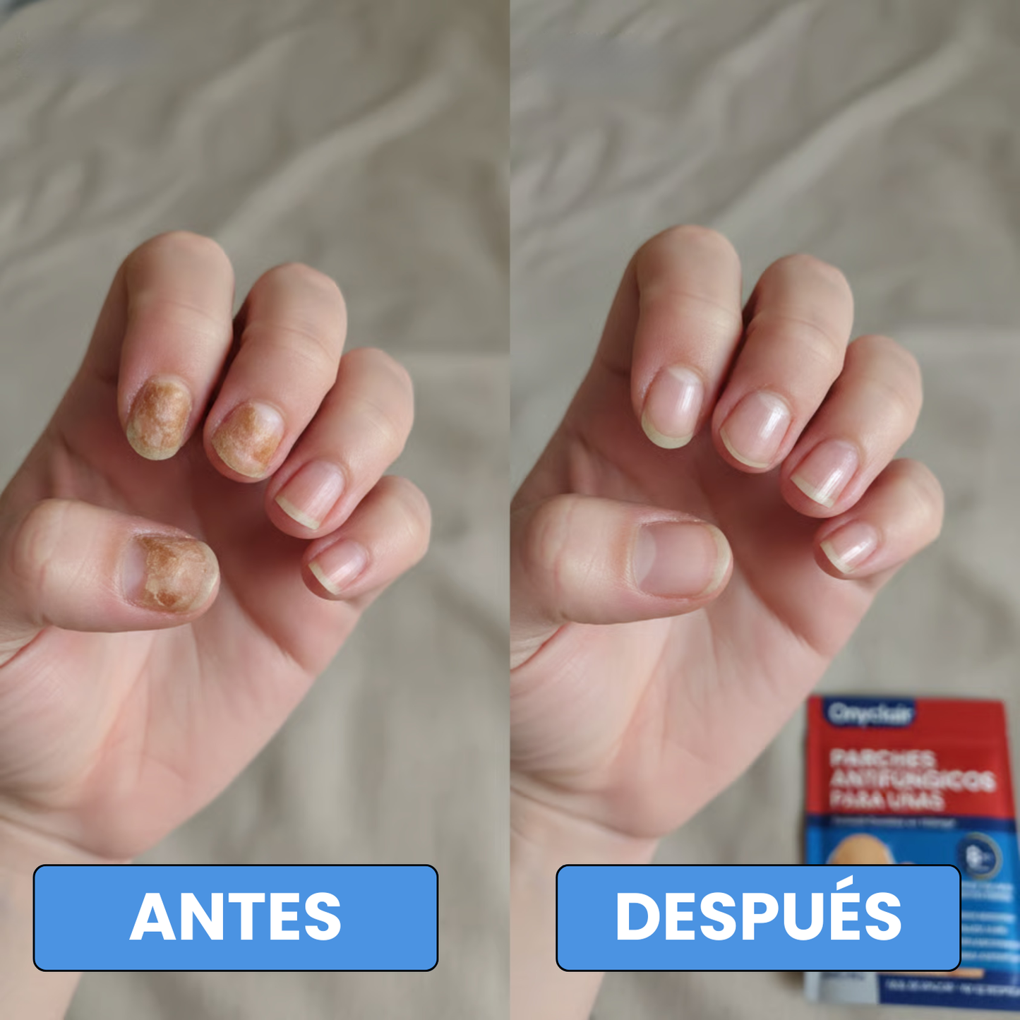 Onyclair® - Parches Naturales Para Tus Uñas