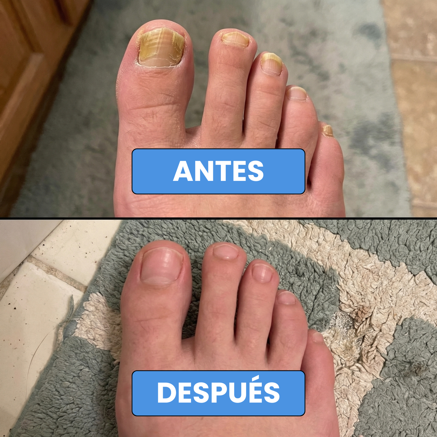 Onyclair® - Parches Naturales Para Tus Uñas
