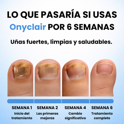 Onyclair® - Parches Naturales Para Tus Uñas